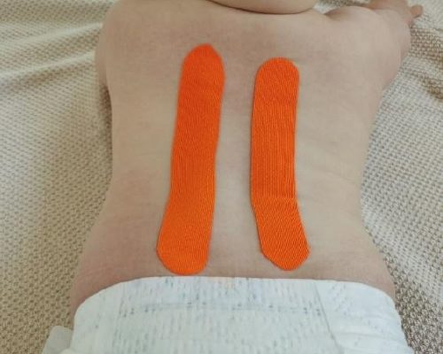 Kinesio Taping bei Kindern Kinesio Taping bei Kindern. 2 orangene Tapes am Rücken eines Babys.